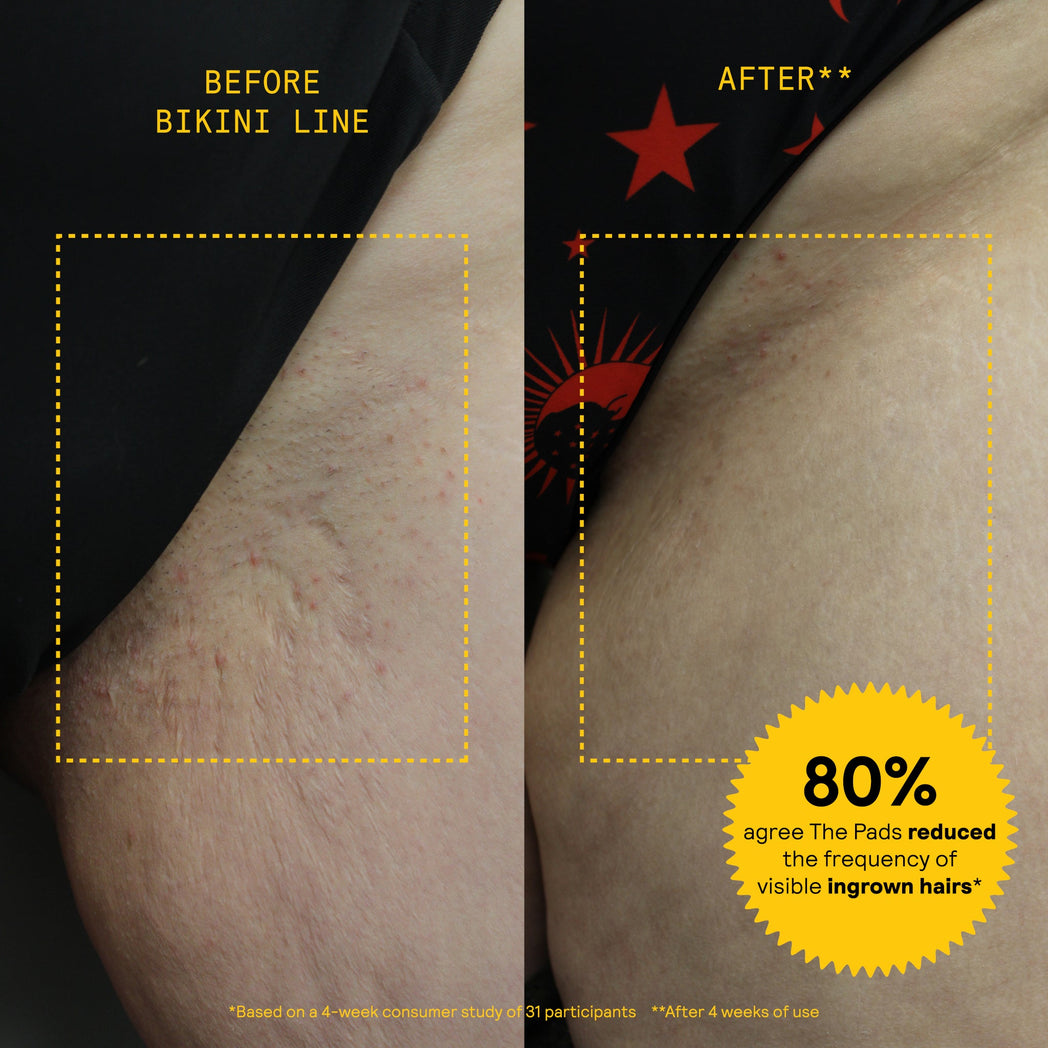 Before and after comparison of bikini line skin showing reduced ingrown hairs and smoother texture after 4 weeks of using the product.