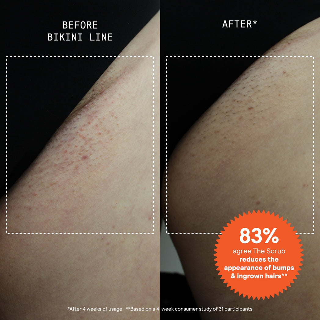 Before and after comparison of bikini line skin showing reduced bumps and ingrown hairs after 4 weeks of scrub usage.